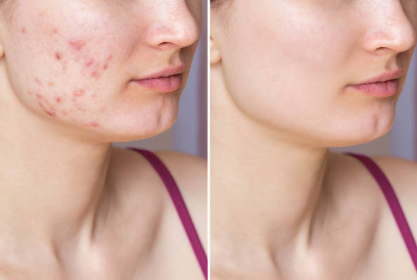Tya Beauty — Patch Anti-Acné Cœur ♥